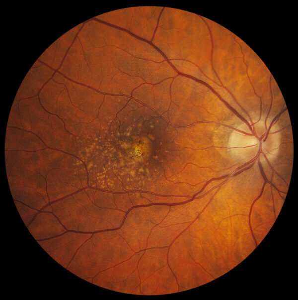 Proliferative Diabetic Retinopathy