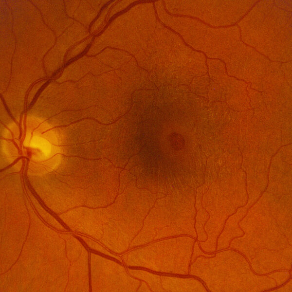 Proliferative Diabetic Retinopathy