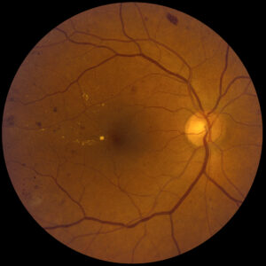 Non-Proliferative Diabetic Retinopathy