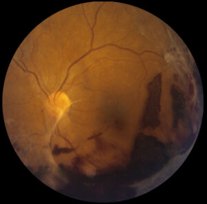 Proliferative Diabetic Retinopathy