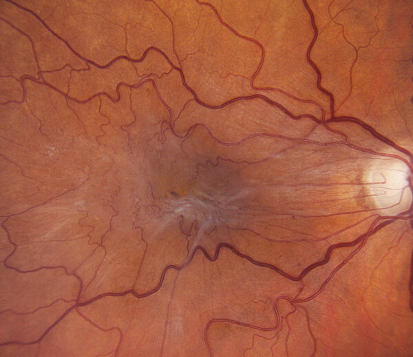 Proliferative Diabetic Retinopathy