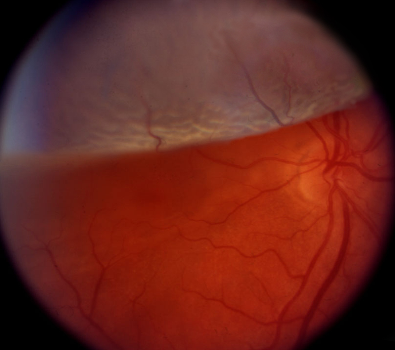 Proliferative Diabetic Retinopathy