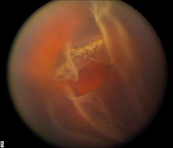 Proliferative Diabetic Retinopathy