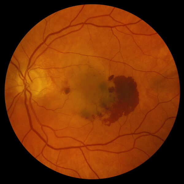 Proliferative Diabetic Retinopathy